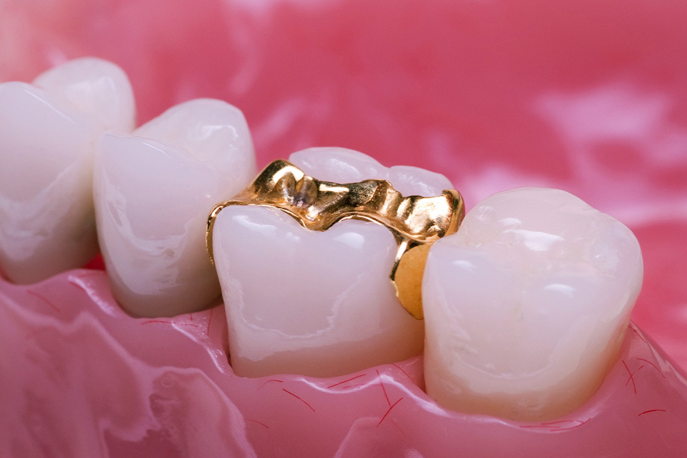 ゴールドインレー