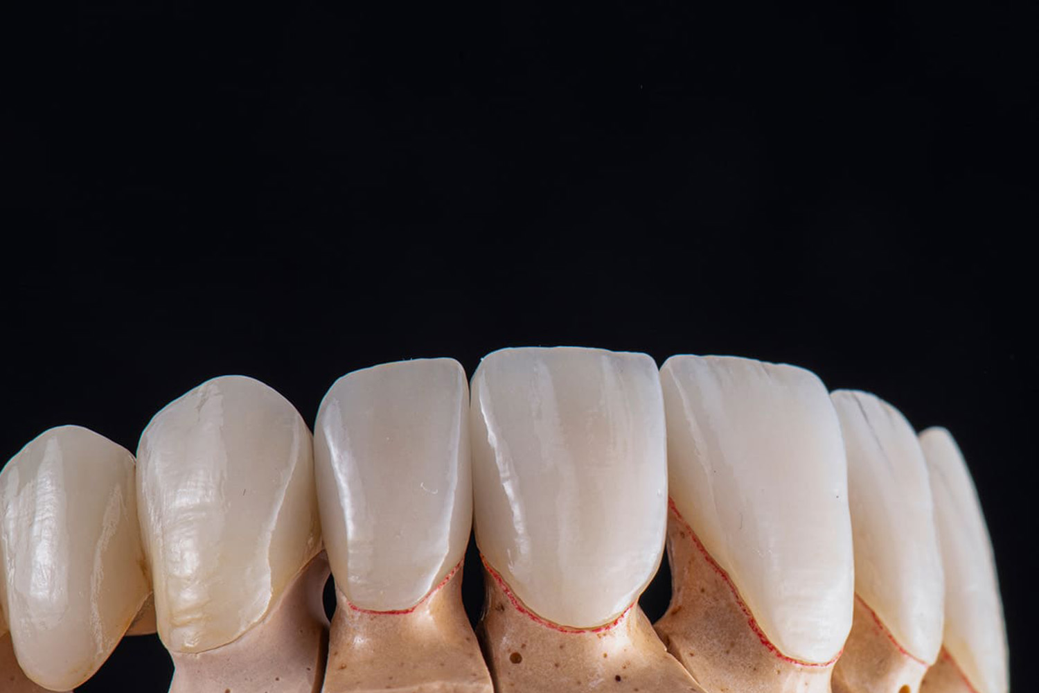 ラミネートべニア