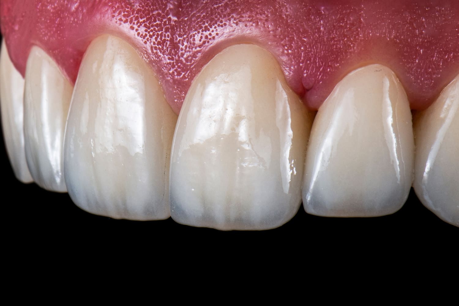 オールセラミック