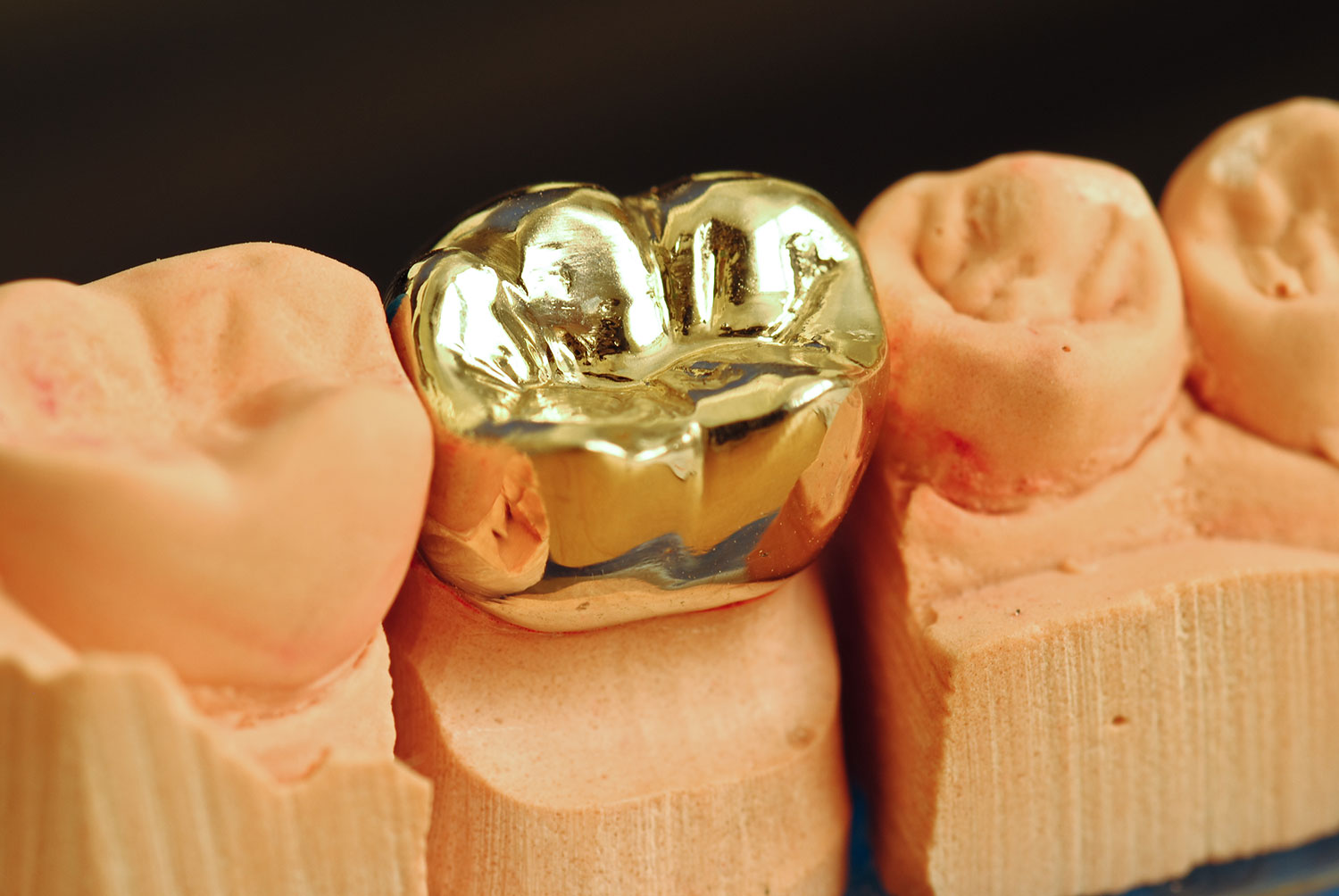 ゴールドの詰め物・被せ物治療