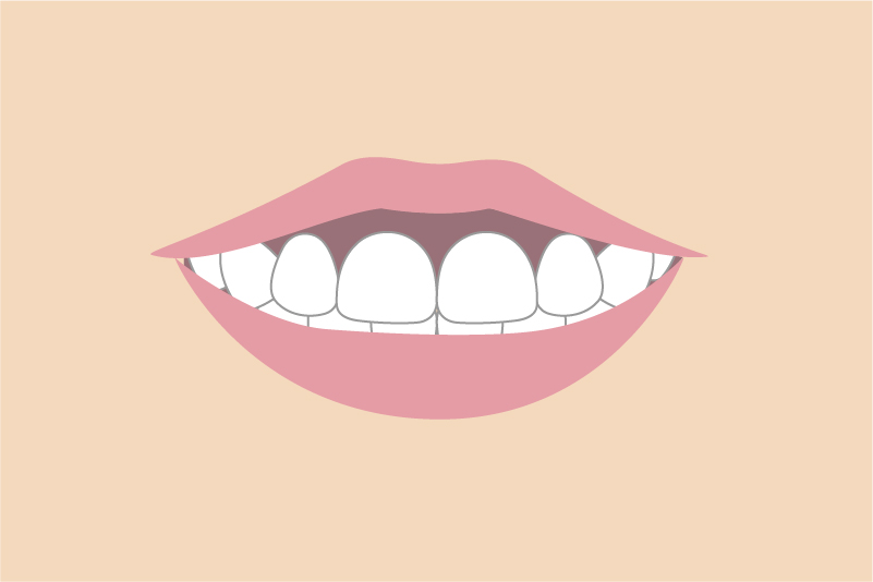 ガミースマイル