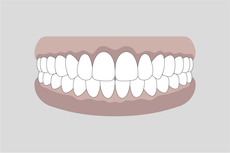 ガムピーリング