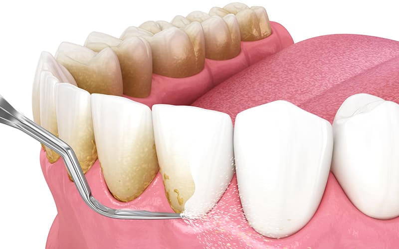 スケーリング（歯石除去）