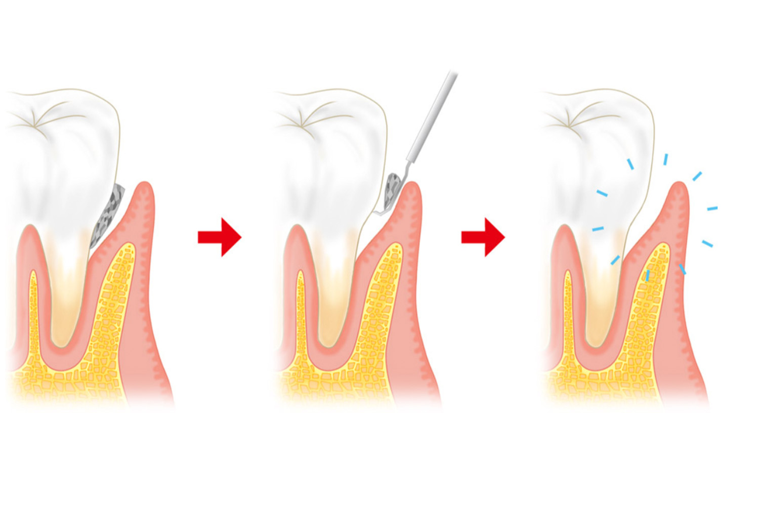 ルートプレーニング