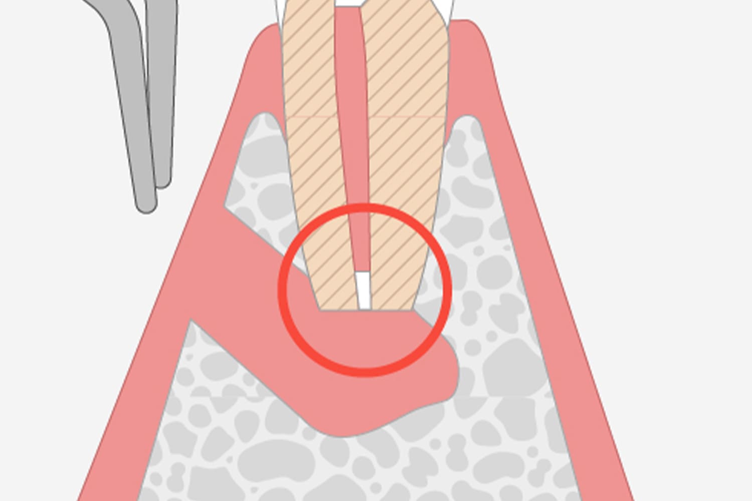高度な技術が求められる「歯根端切除術」の実施