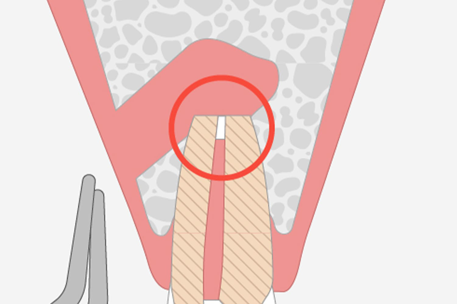 高度な技術が求められる「歯根端切除術」の実施
