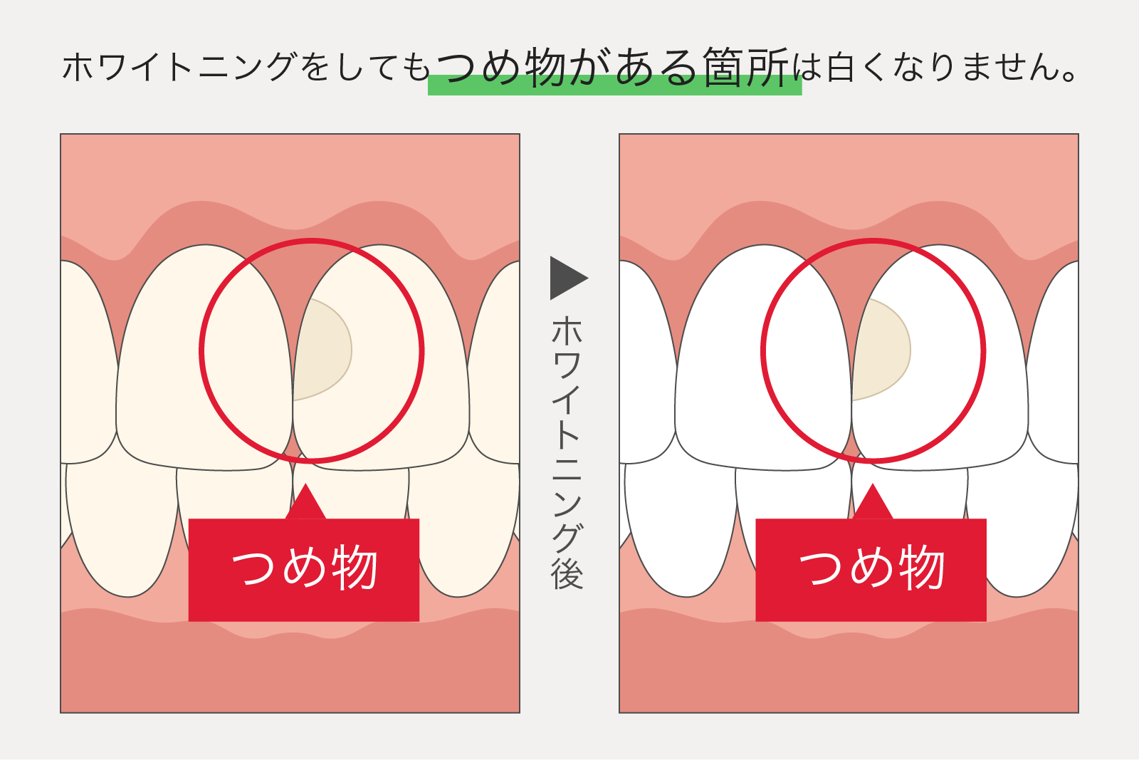 ホワイトニングの注意点